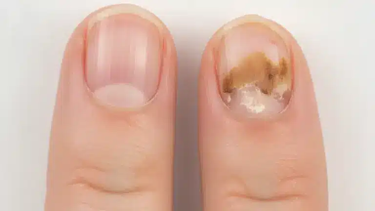 Acabe com o fungo das unhas de vez agora