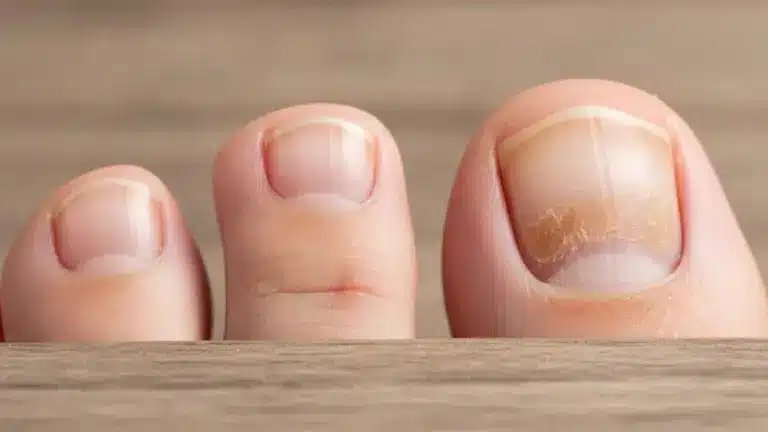 Receitas caseiras comprovadas para tratar infecções de unhas