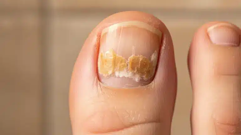 Unhas com Fungo: O Método Caseiro Mais Eficaz para Acabar com o Problema de Vez
